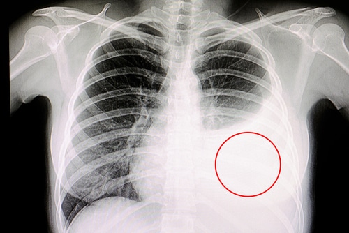 Pleurodesis: Explaining Its Function and Procedure | Mesothelioma