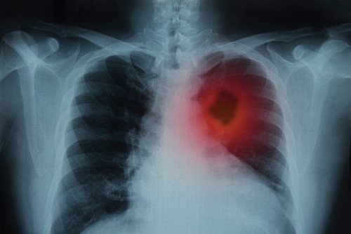Asbestos-Related Lung Cancer | Mesothelioma We Can Help
