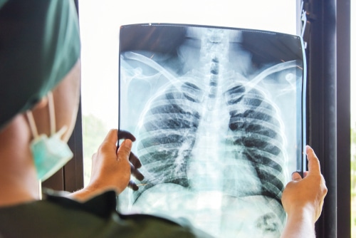 Asbestosis Symptoms and Diagnosis | Treatment and Management