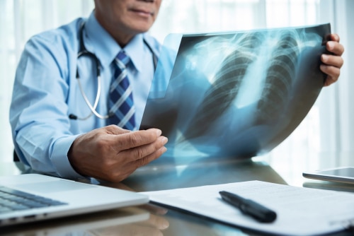 Doctors for Mesothelioma Specialists in Asbestos-Related Cancer