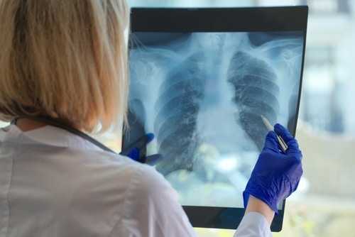 Extrapleural Pneumonectomy Surgery (EPP) for Mesothelioma