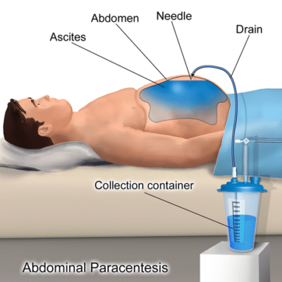 Paracentesis Surgery for Mesothelioma Patients | Procedure & Risk