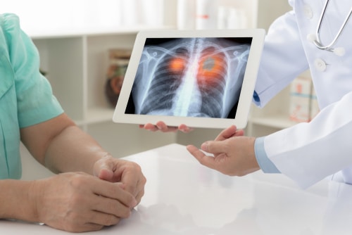 Pleural Effusion from Asbestos Exposure | Symptoms & Treatments