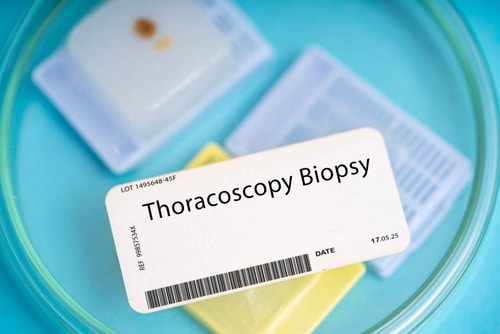 Thoracoscopy Surgery for Mesothelioma | Treatment Procedure