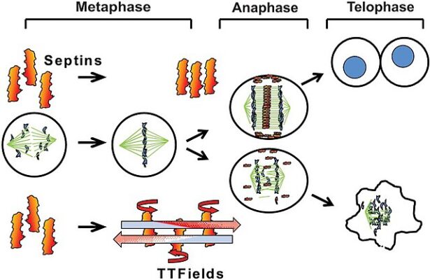Tumor Treating Fields (TTFields) for Mesothelioma Treatment