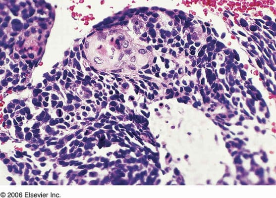 Biphasic Mesothelioma | Diagnosis, Symptoms, & Treatments