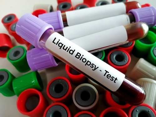 Mesothelioma Biopsy Types and Procedure | Diagnostic Process