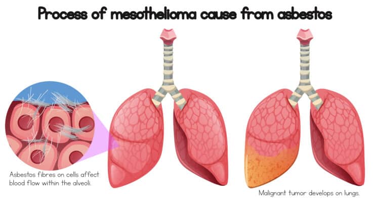 Mesothelioma Causes | Asbestos Exposure | Reducing the Risk