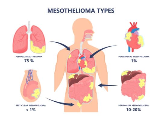 Mesothelioma Types | Classifications and Treatment Factors