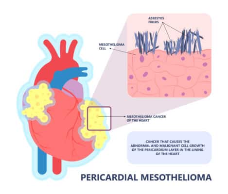 Pericardial Mesothelioma | Symptoms and Treatment Options