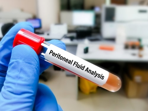 Peritoneal Effusion | Mesothelioma Symptom | Asbestos Exposure