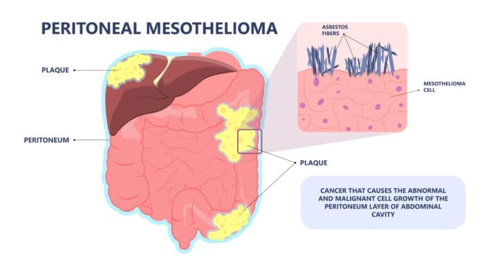 Peritoneal Mesothelioma | Symptoms, Survival Rates, & Treatment