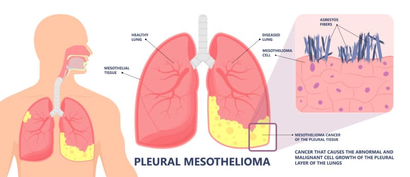 Pleural Mesothelioma | Common Symptoms | Exposure to Asbestos