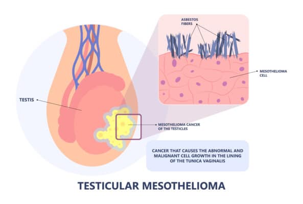 Testicular Mesothelioma | Causes, Symptoms, and Treatment